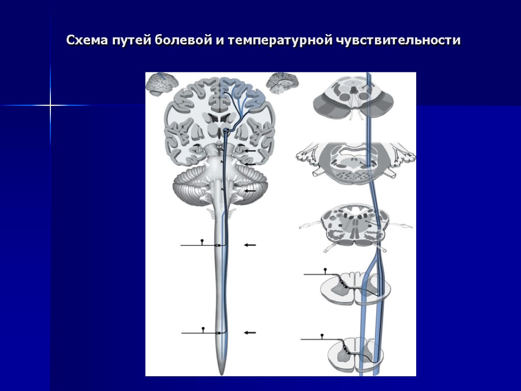 Схема путей болевой и температурной чувствительности